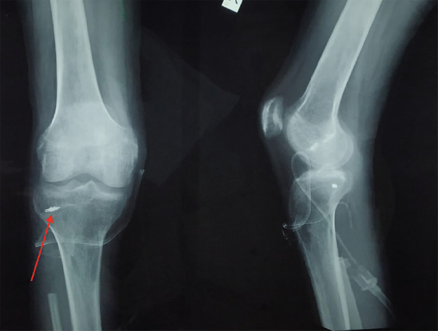 Post-operative radiograph with proximal fibula excision and reattachment of the lateral ligament complex by suture anchor (arrow).